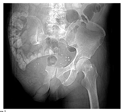 hemipelvectomy female|Functional Outcomes and Quality of Life After Tumor.